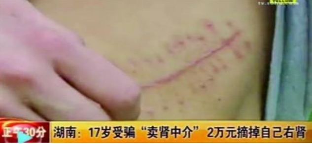 9年前，那个卖肾换苹果手机的17岁小伙子，后来到底怎么样了