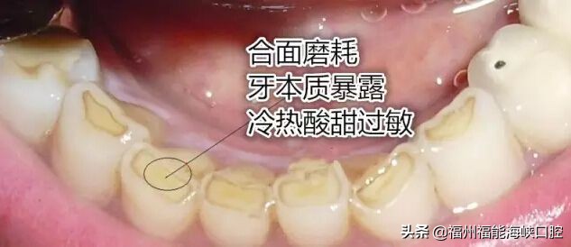 牙缝大是什么征兆？牙医：牙缝变大的主要原因、解决方法已整理好