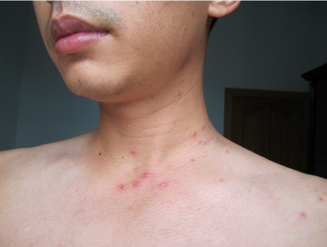 男子错把艾滋病当成皮肤病？出现艾滋病后，哪些表现比较明显？