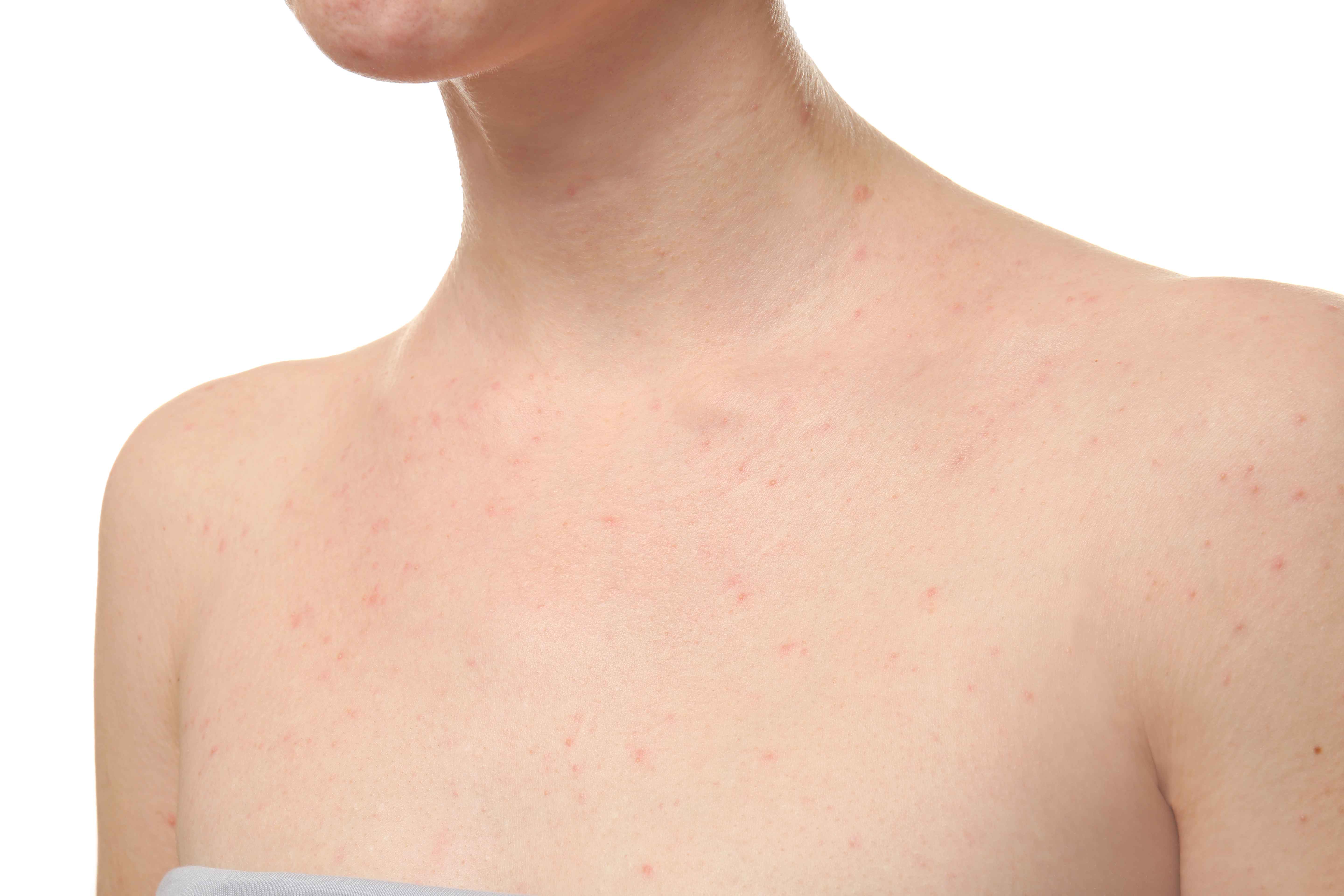 湿疹容易反复发作，需重视，掌握这5个护理方法，或能根治湿疹