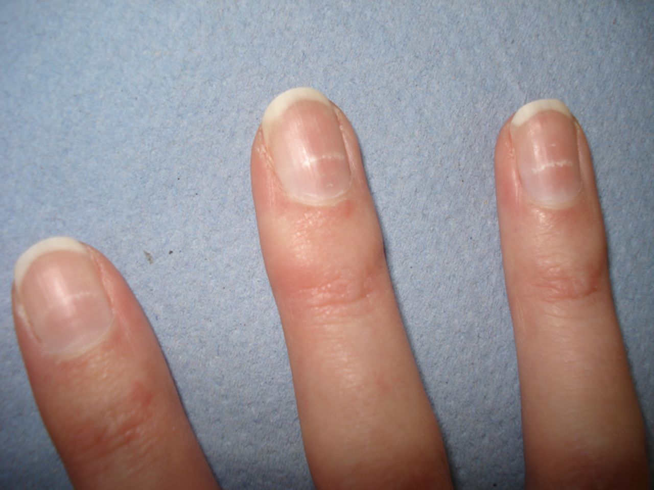 指甲有斑,竖纹,变色预示什么疾病?除了看"月牙"还知道哪些?