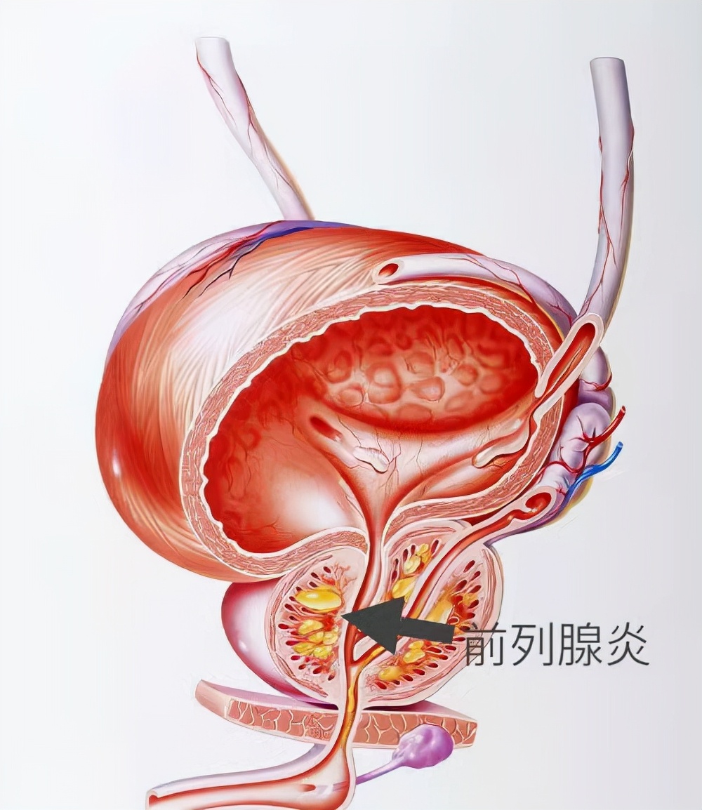 前列腺增生治疗(前列腺增生的“苦”，懂得都懂！3种一线治疗药物，医生一文说清)