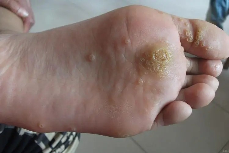 突出于皮肤,呈丝状带蒂,多见于颈部,眼睑,腋下等部位的是丝状疣,有