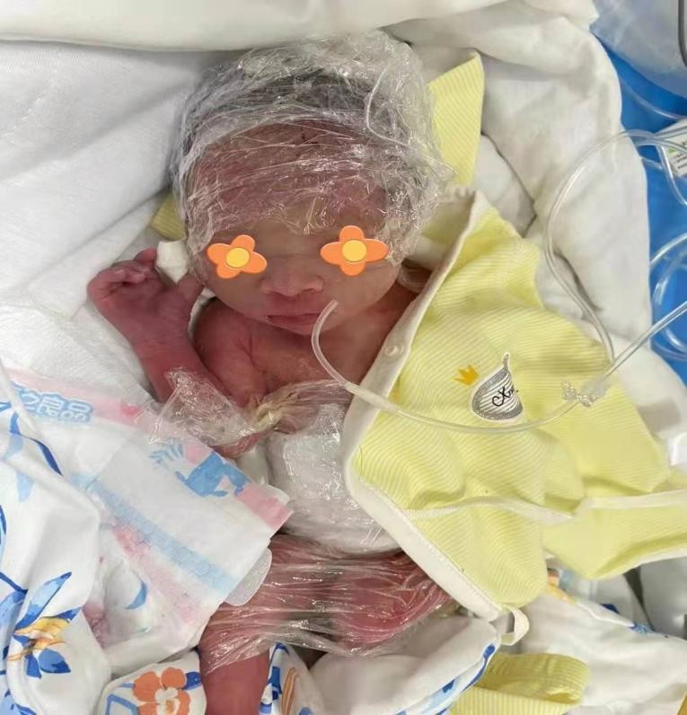 盐亭县人民医院儿科成功救治院内首例极早早产儿