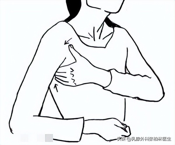 女性乳房反复出现湿疹症状，却意外发现是乳腺癌。这几点要注意