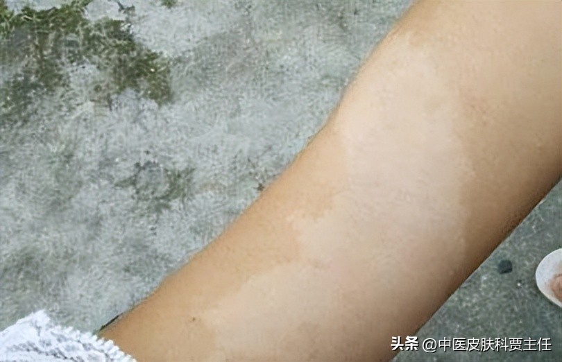 白色糠疹一般不需要特殊治疗,当病情发展到一定程度后可以自动停止,并