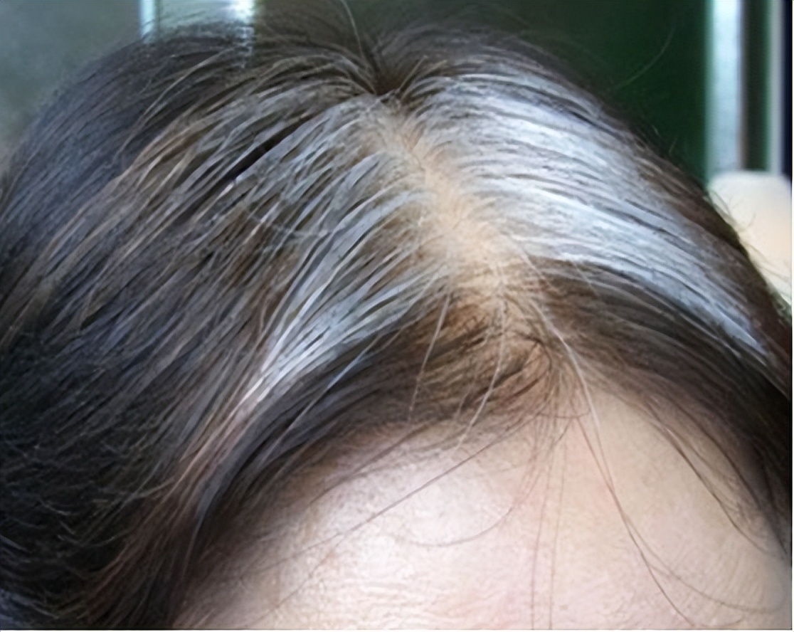 遗传因素很多人在父母那一辈就是早生华发,那孩子肯定出现白发的速度