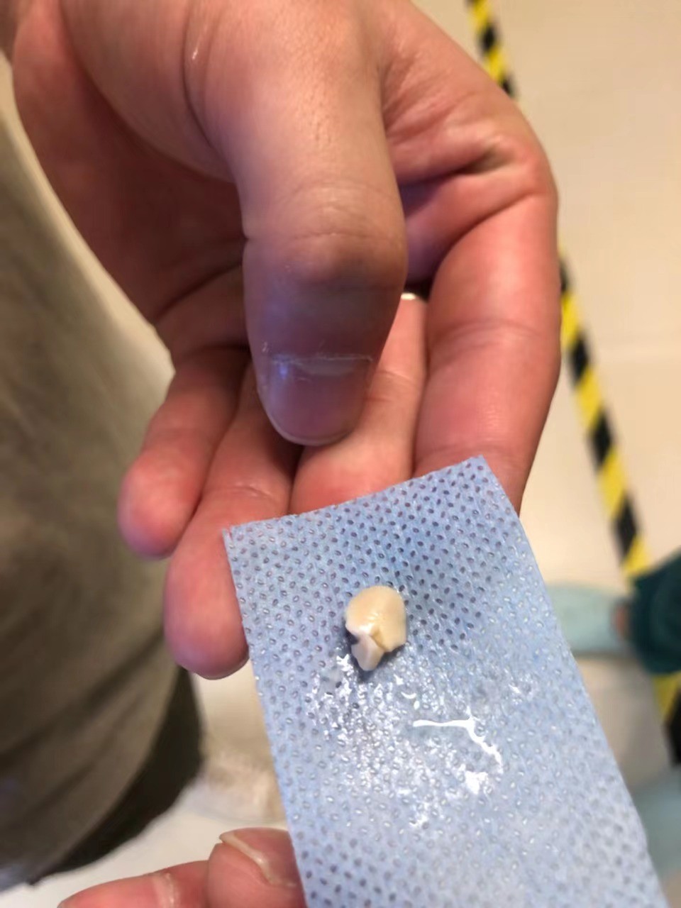 气管异物诡秘凶险，华西二院眉山市妇女儿童医院技术精良明察秋毫