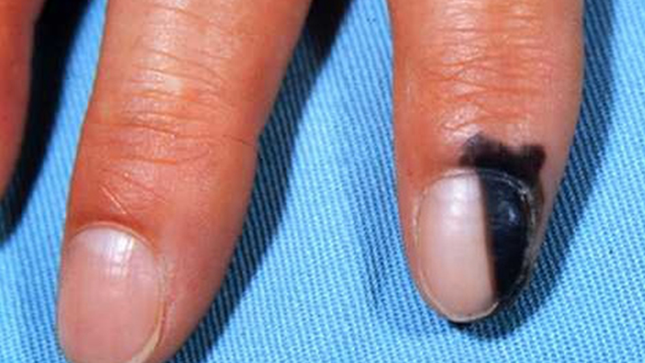 提醒:指甲若长成4种样子,可能是癌或疾病的信号,还请留心观察