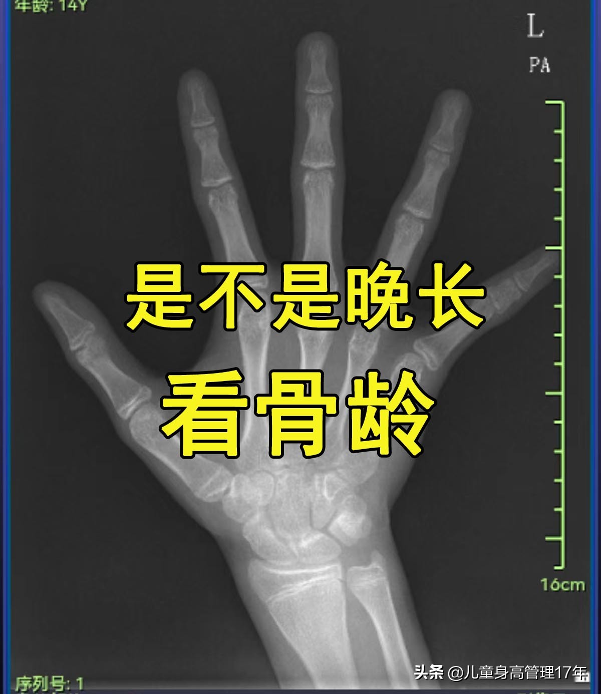 15岁了可只有156的身高(晚长的孩子10个有8个都长不高！早长还是晚长？几十块钱就知道)