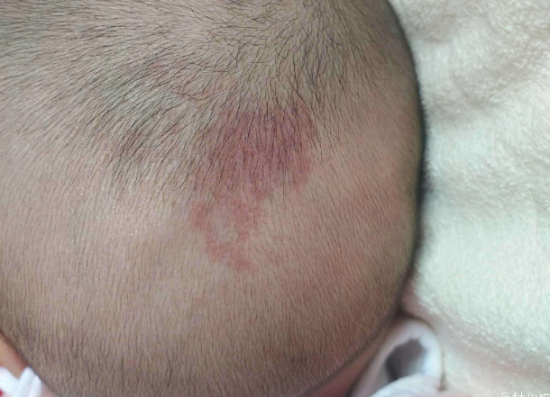 宝宝后背满是青色胎记,网友:这是被打了多少棍才下来的