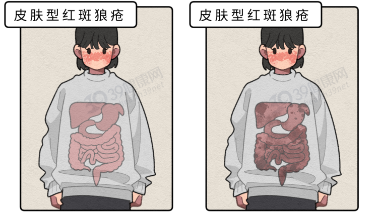 皮肤突然长红斑？当心已被“不死癌症”盯上，出现这些表现请警惕
