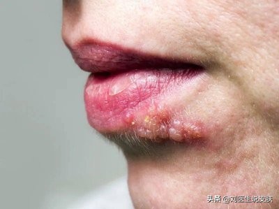 春节大吃大喝,嘴巴起泡不只上火,而是单纯疱疹,3类人要注意