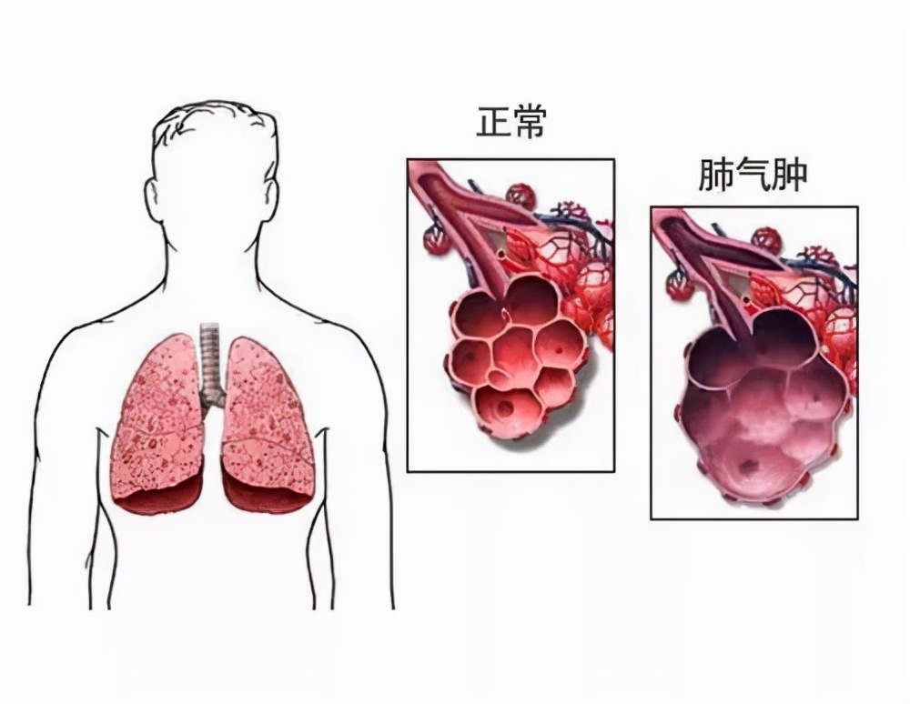 肺气肿导致呼吸困难，总感觉喘不上气是怎么回事？