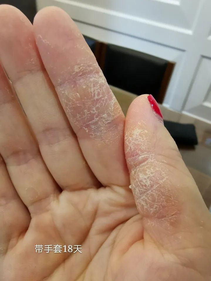 手上濕疹怎么治療（0用藥，只做這件事，就緩解多年頑固手濕疹！）