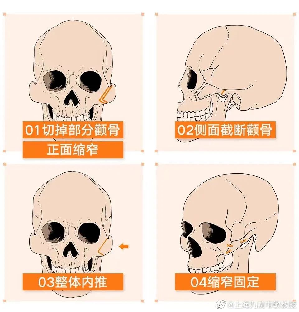 韦敏教授科普 | 苹果肌与颧骨突出，青春态VS衰老相