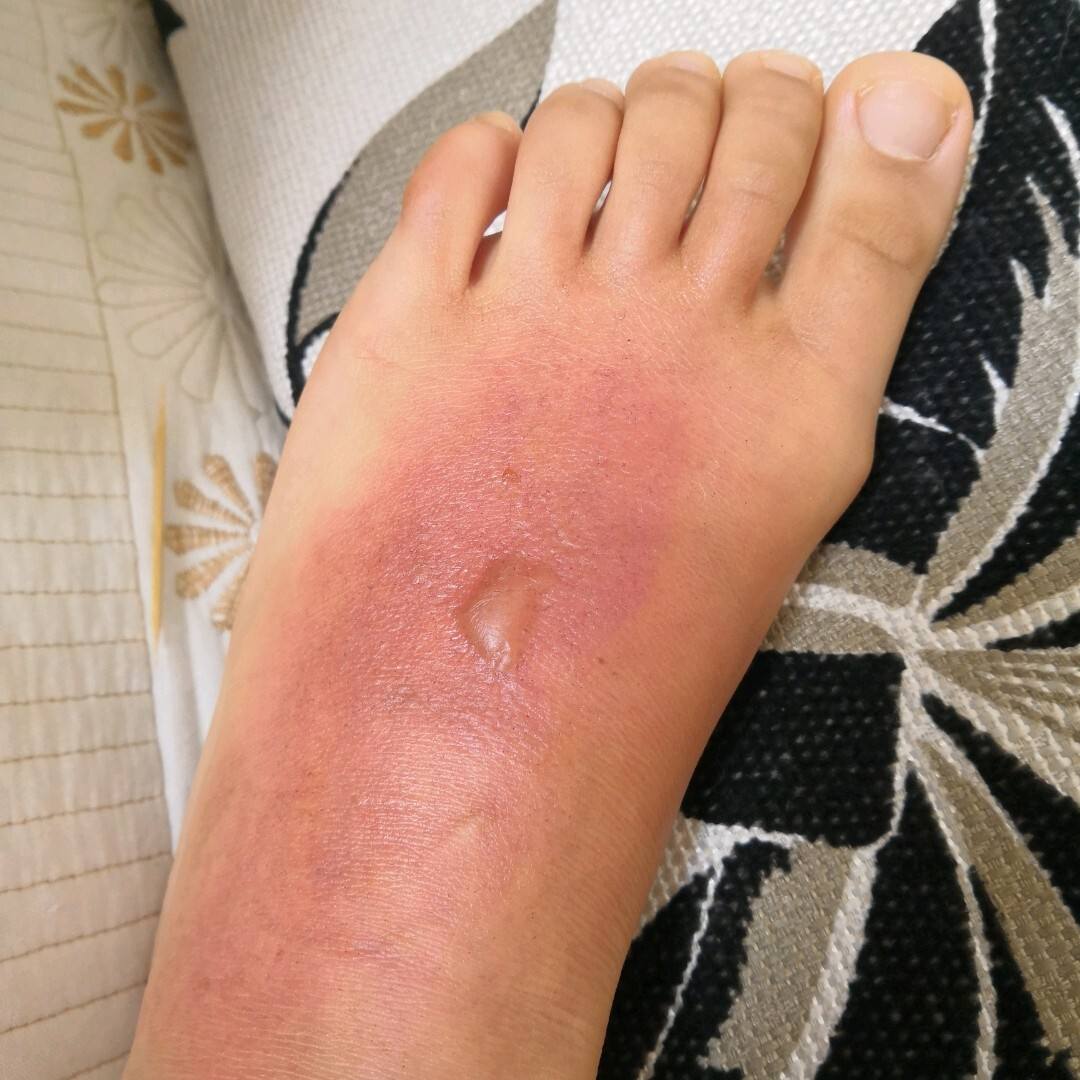 孩子被100度开水烫伤,妈妈一小时五字处理,医生:有文化