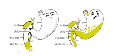 为什么会得胆汁反流性胃炎?究竟是怎么引起的,什么办法能调理?