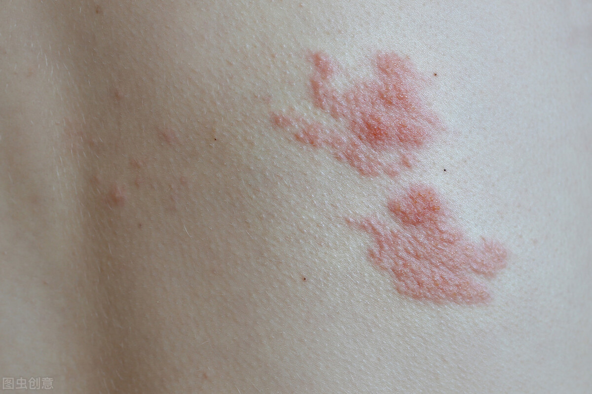 龙","蛇串疮",是一种常见的病毒性皮肤病,病原体是水痘-带状疱疹病毒