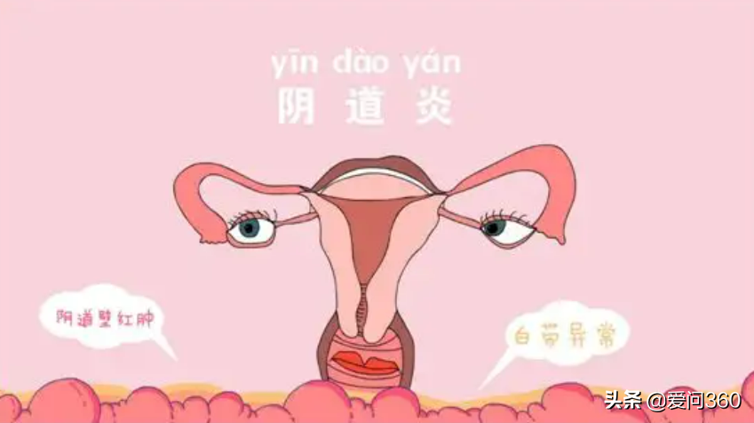 阴道炎前期释放的信号你遇到过几个？早点知道，别大意