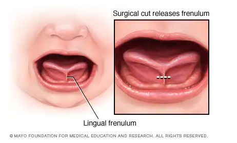 怎么判断婴儿舌头短(快看看孩子的舌头) - 乐宝宝贝