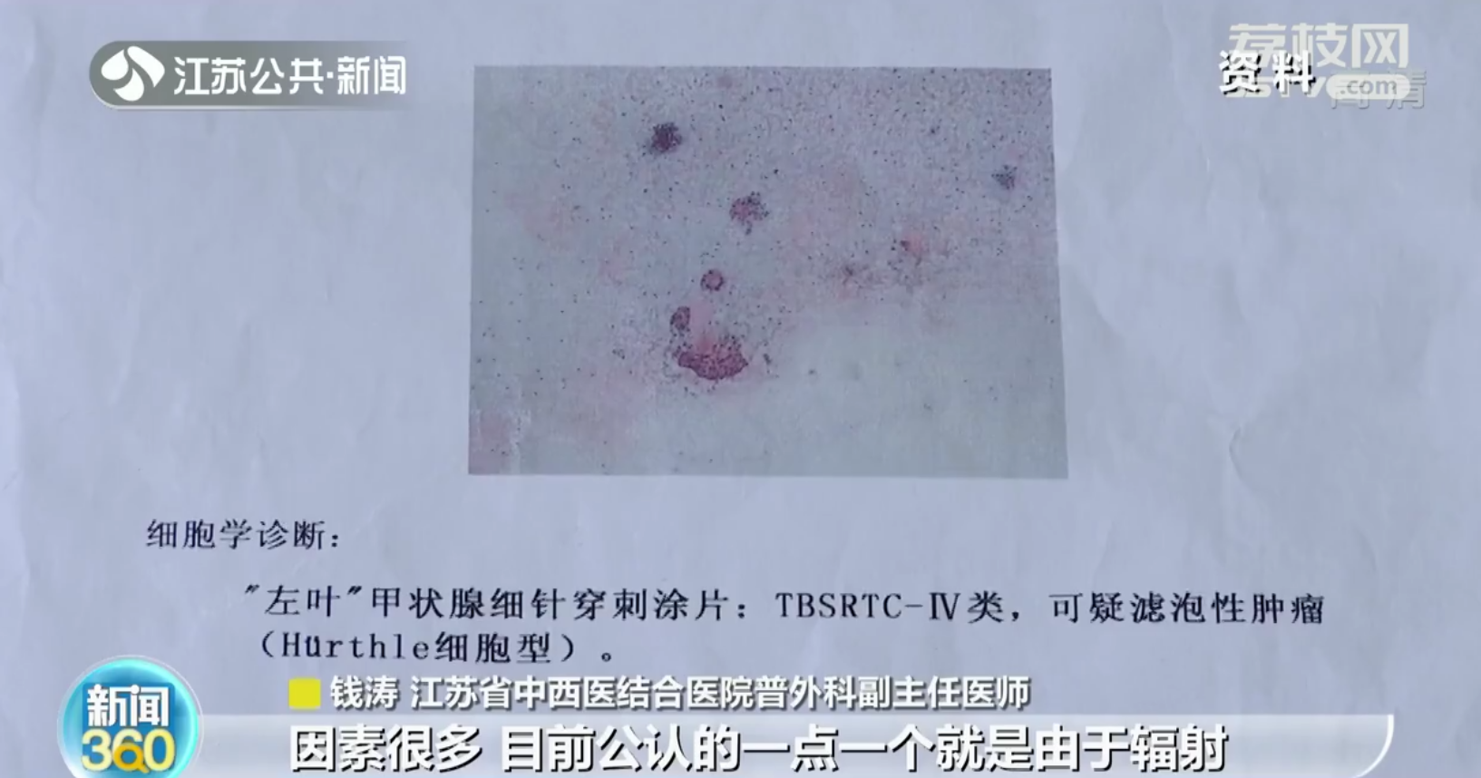 南京：16岁少女脖子变粗 竟是长了个超过六厘米的肿瘤