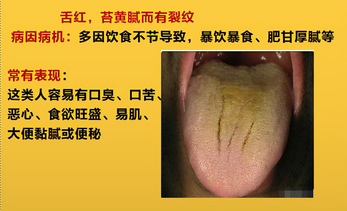 舌头边缘有齿痕，舌苔中间有裂纹？3种齿痕5种裂纹，你是哪一种？