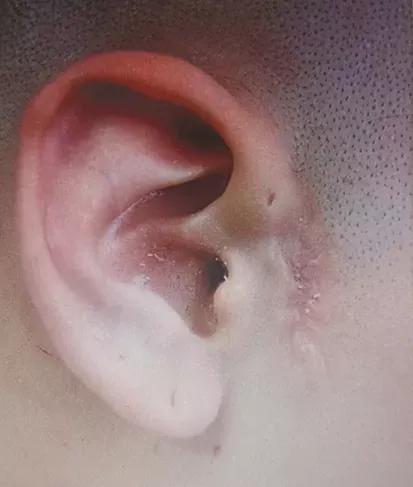 先天性耳前瘘管反复复发怎么办?