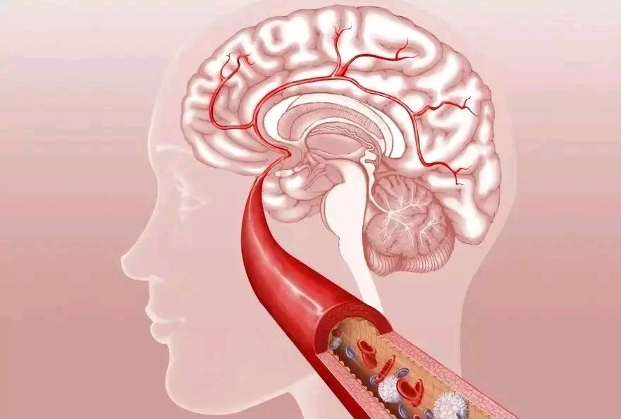 美阿沙坦，1片即可降17.6mmHg，多年漂泊终于去年登陆中国市场