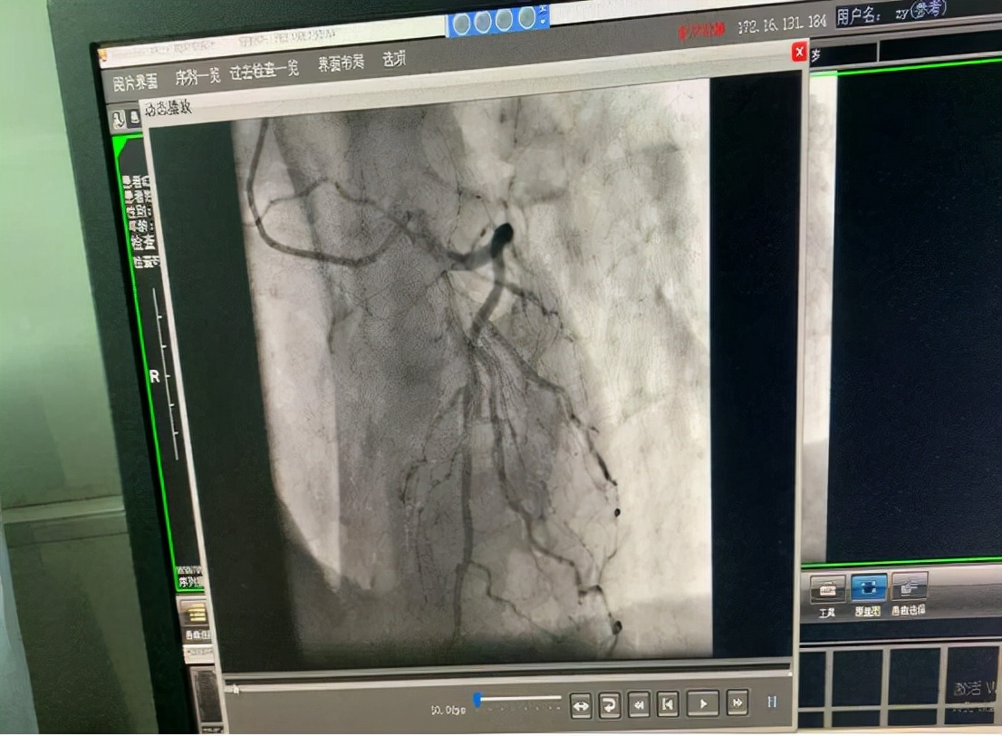 冠心病检查不只有造影，更便宜、有效地检查门诊就能做，值得收藏