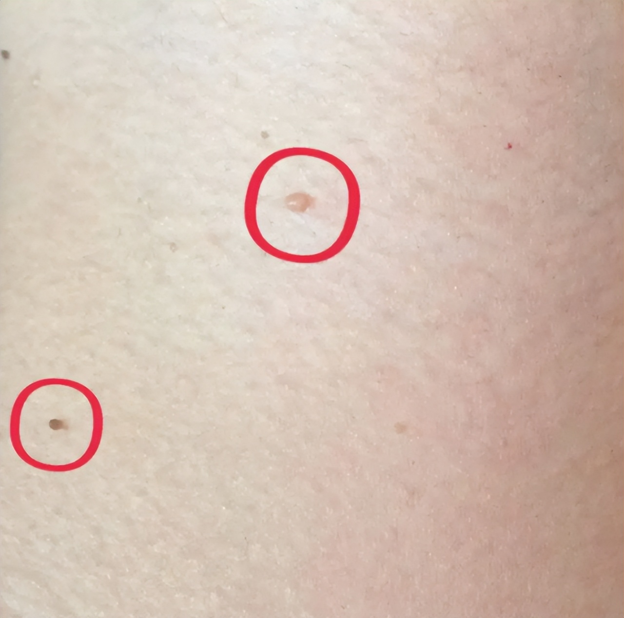 脖子和腋下的"小肉粒"是什么?能直接用手揪掉吗?看完要记牢