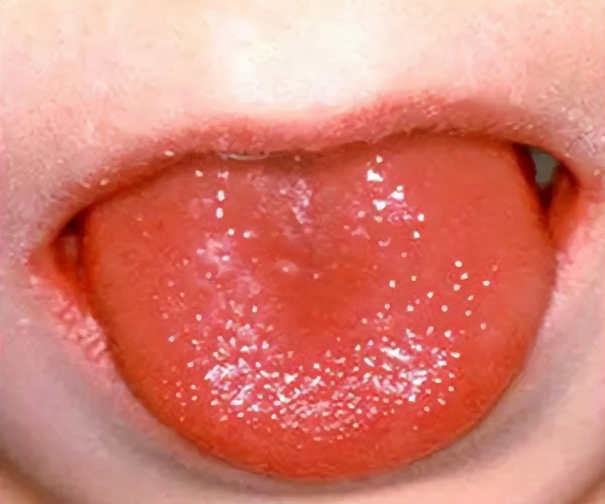 快看看孩子的舌头,出现这种情况,请立马就医(3