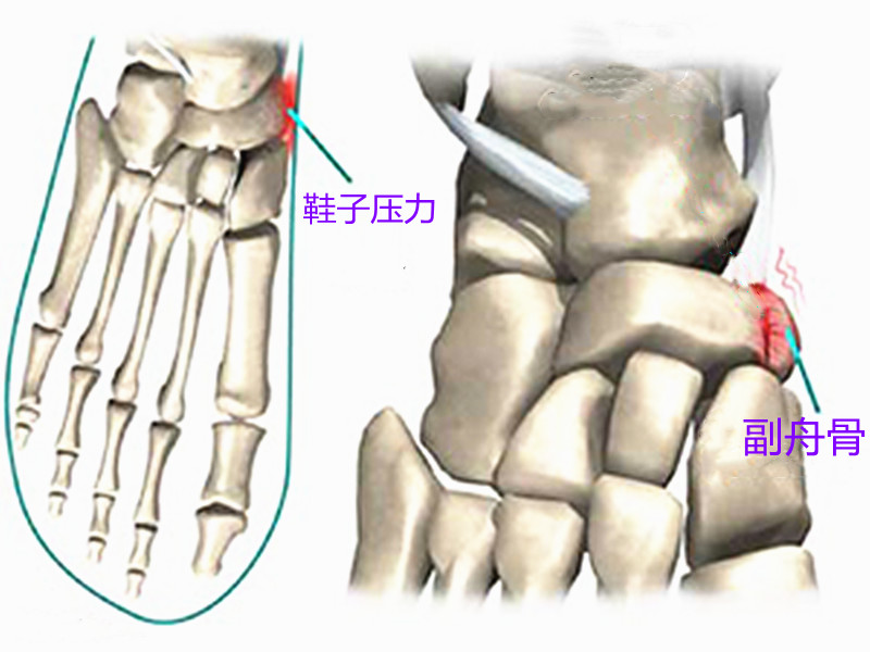 走多了就疼,脚上长了个硬疙瘩,什么是副舟骨综合征?