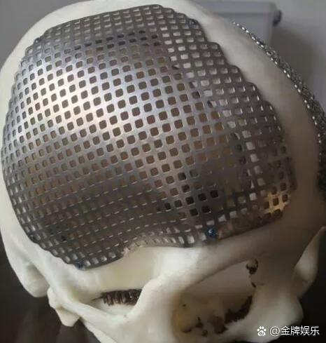 林志颖已苏醒面部置入钛合金手术恐影响容颜