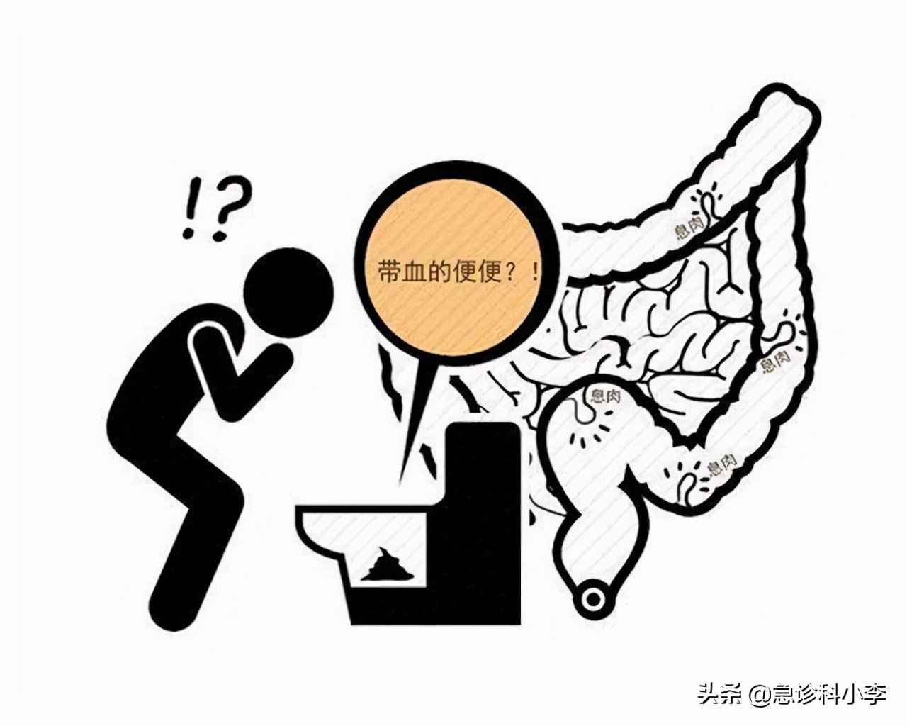 30岁小伙每天大便两三次，确诊肠癌！3种大便异常是身体“警报”