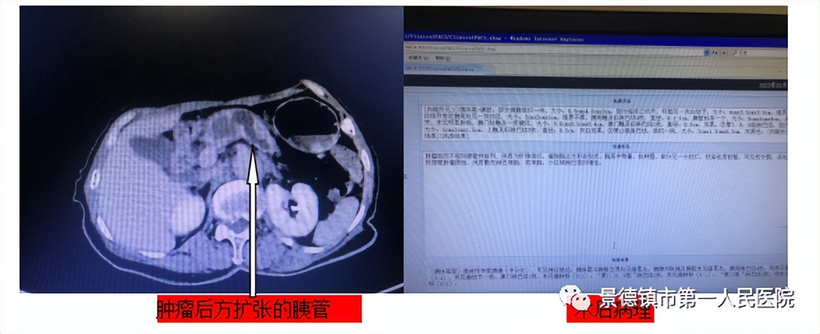 景德镇市第一人民医院肝胆外科成功完成数例高难度胰腺手术