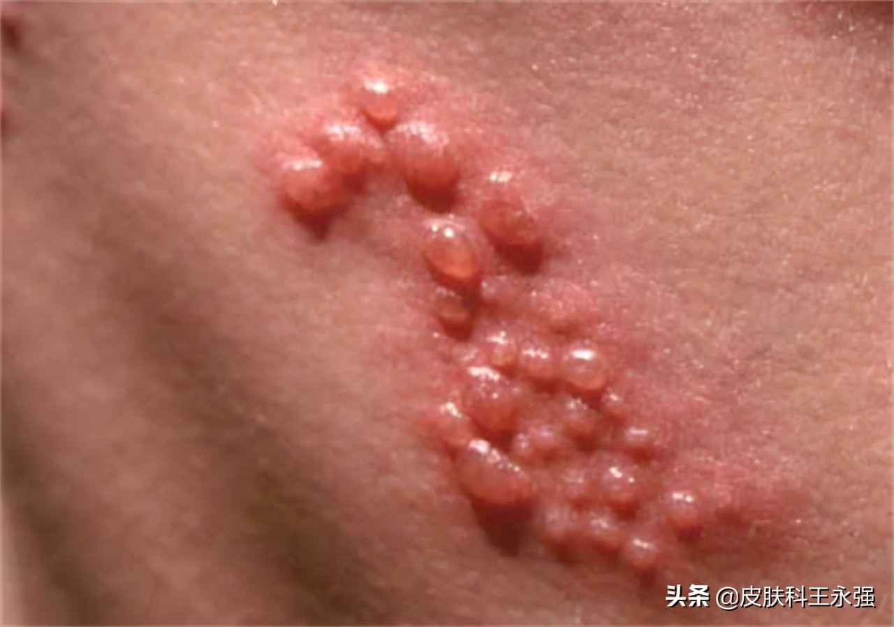 男性生殖器疱疹图片(有一种剧痛叫) 