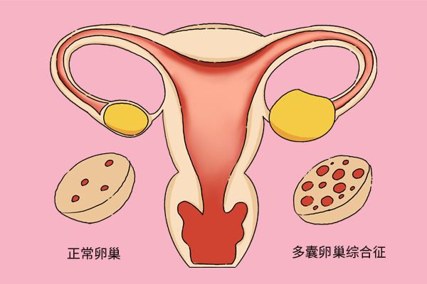 女性为什么会卵巢早衰？卵巢早衰的5大共性，不可大意
