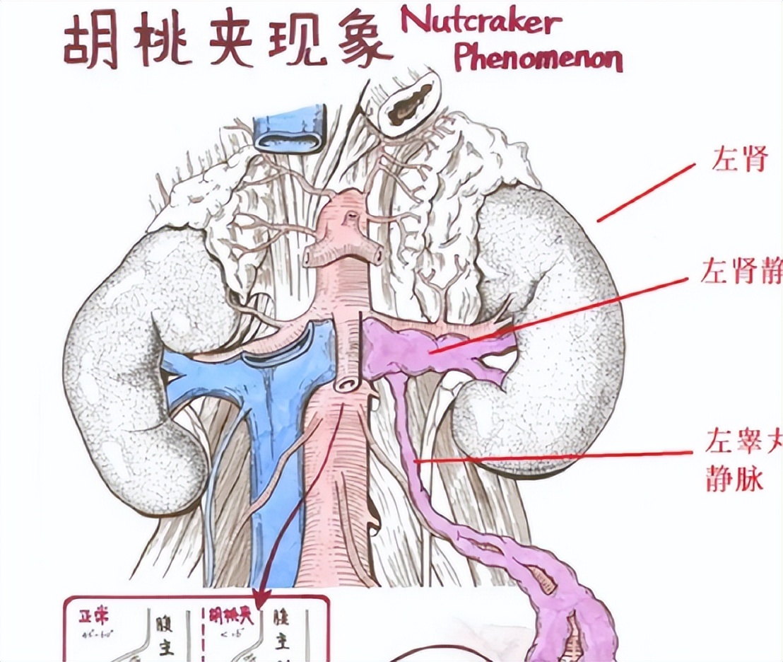 女子腰痛誤診腰椎間盤突出,直到出現血尿,醫生:胡桃夾現象