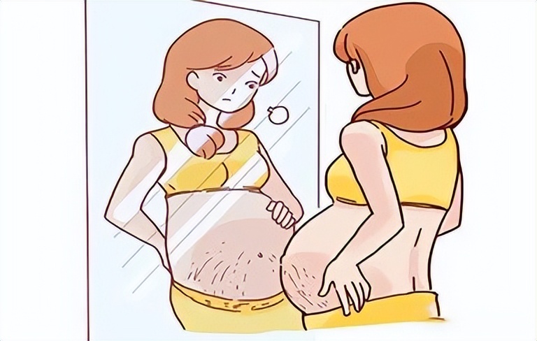 令孕妈们烦恼的妊娠纹该如何消除?