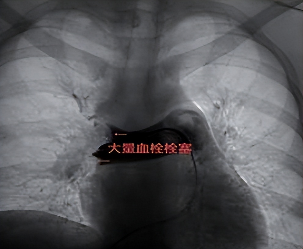 不打烊 更方便 周围血管科（介入科）开设周六全天门诊