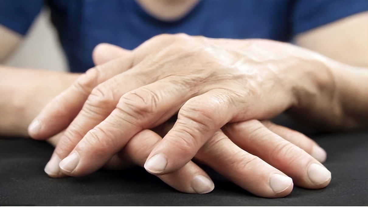 手肿是什么原因 女人手肿是什么病的前兆 