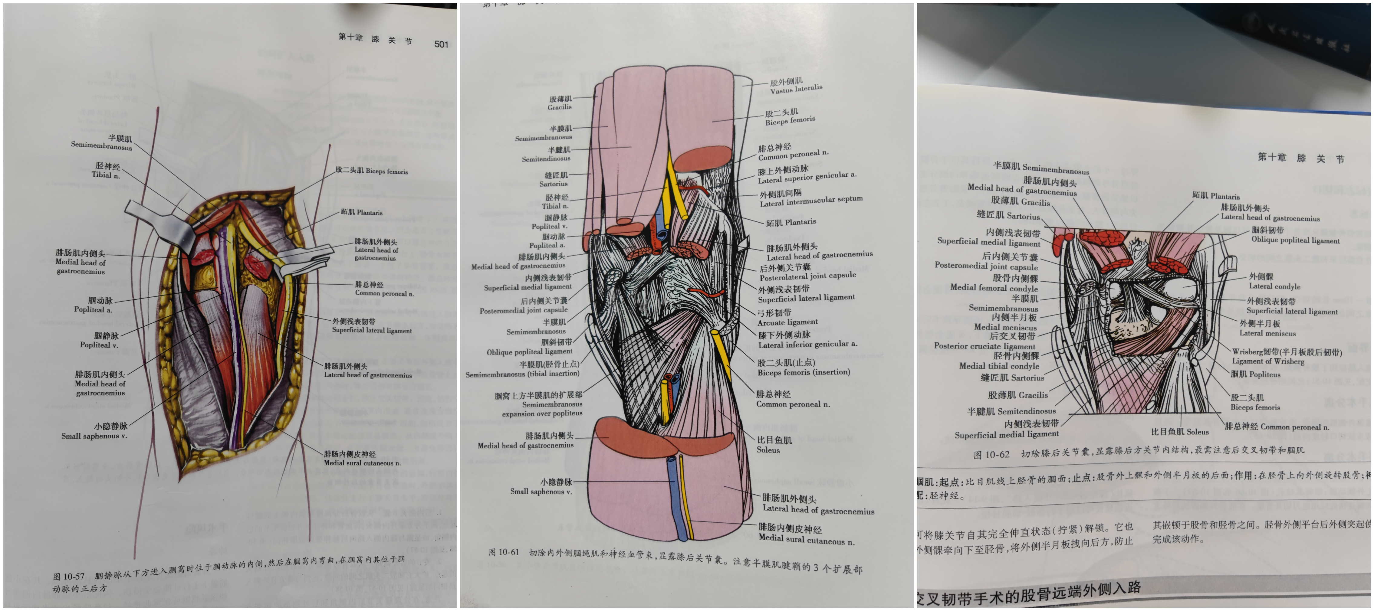 黄梅县中医院骨伤1科开展膝后正中微创入路治疗后叉止点撕脱骨折