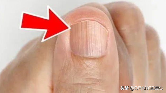 手指甲有竖纹是怎么回事（手指甲有竖纹代表着什么？可能是身体求救的信号）
