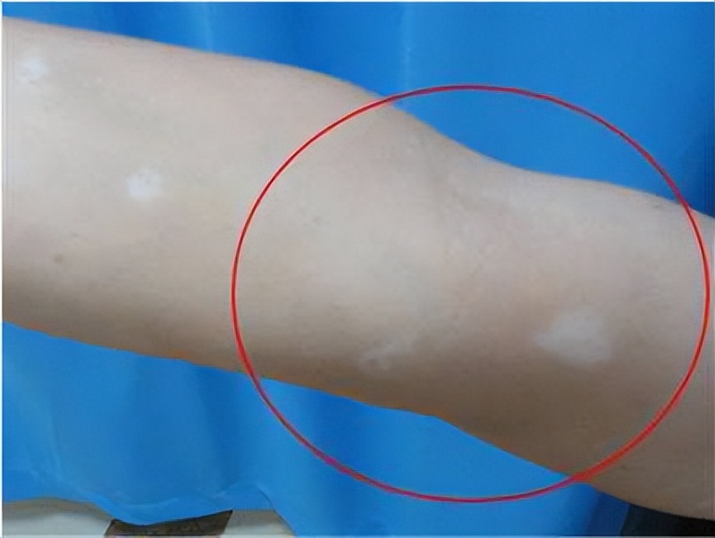 治疗白斑病哪个好(4种常见白癜风用药,哪一种效果更好?都有什么特点?