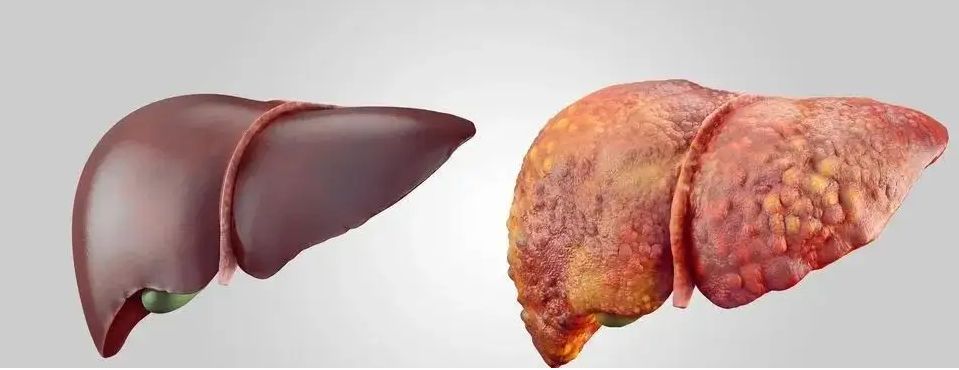 48岁的女子被诊断为肝癌,提醒:无端出现这4种症状要警惕