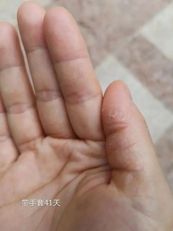手上濕疹怎么治療（0用藥，只做這件事，就緩解多年頑固手濕疹！）