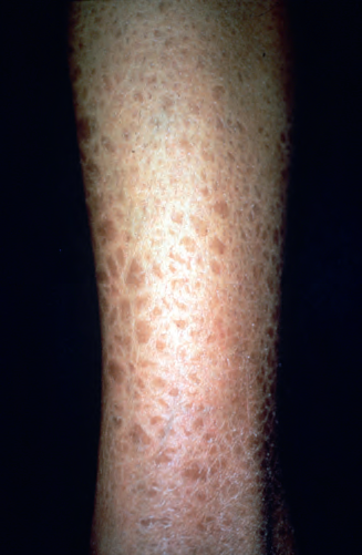 皮肤结节图片(结节病的皮肤改变)