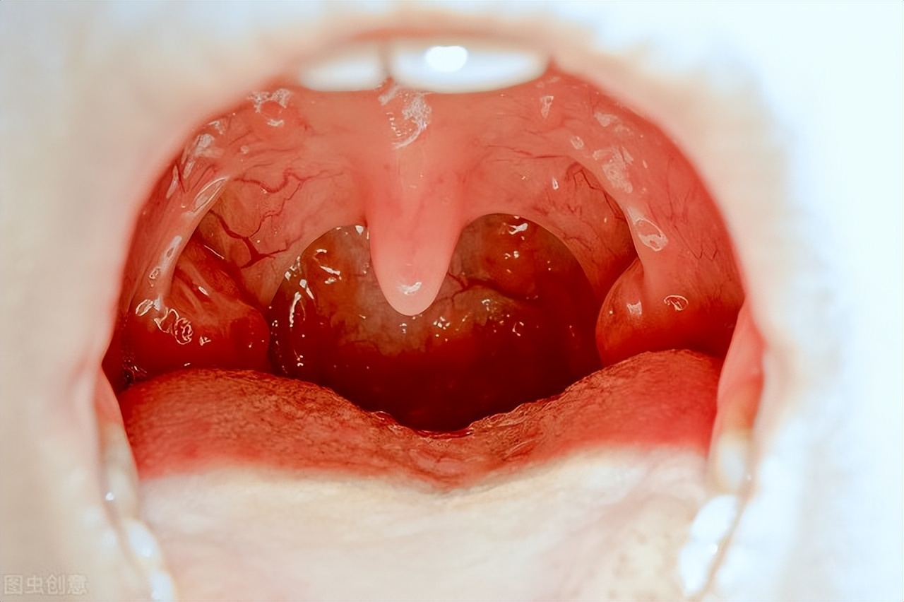 扁桃體發炎吃什麼水果 扁桃體發炎忌口水果-百科叔叔
