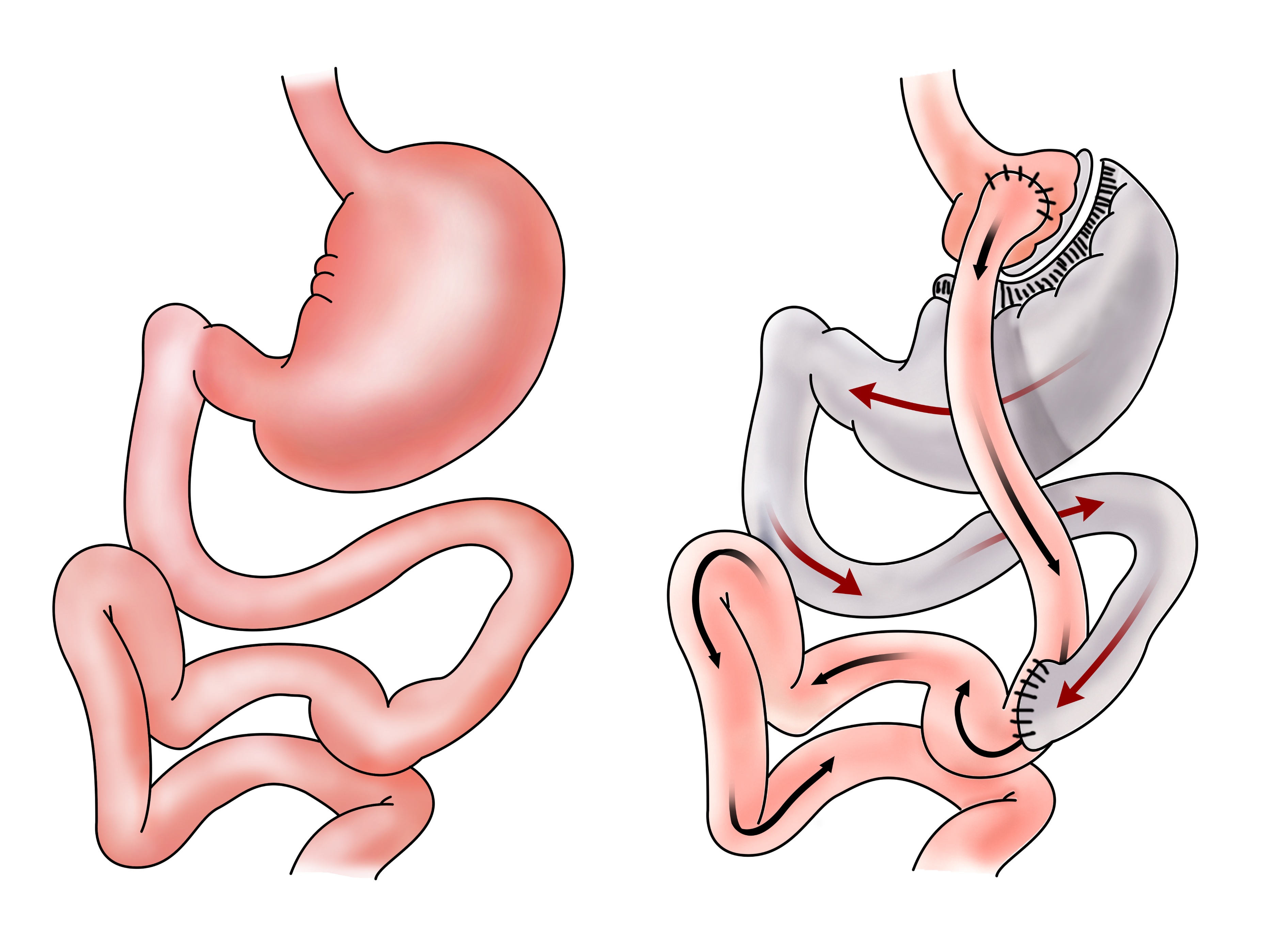 胃套扎手术示意图图片